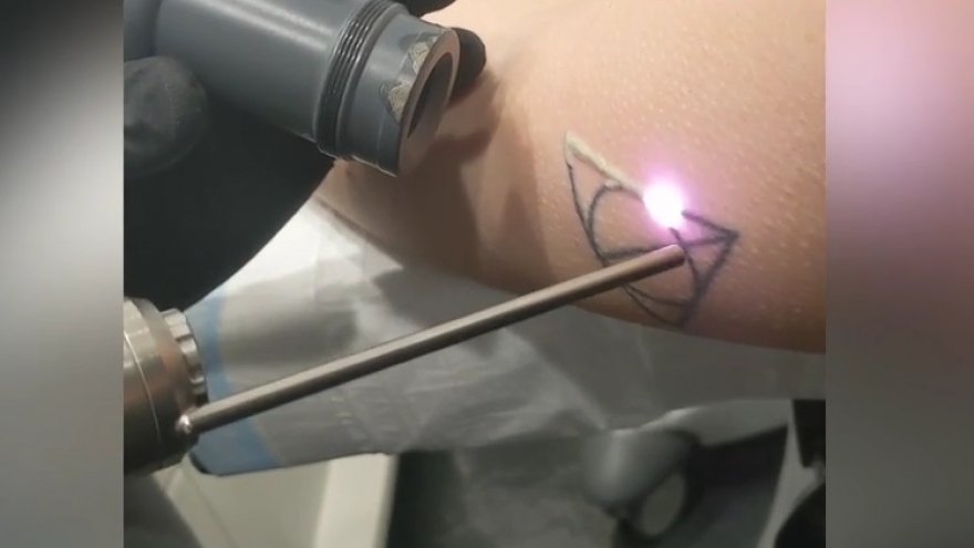 Cận cảnh tia laser loại bỏ hình xăm Harry Potter trên cơ thể người
